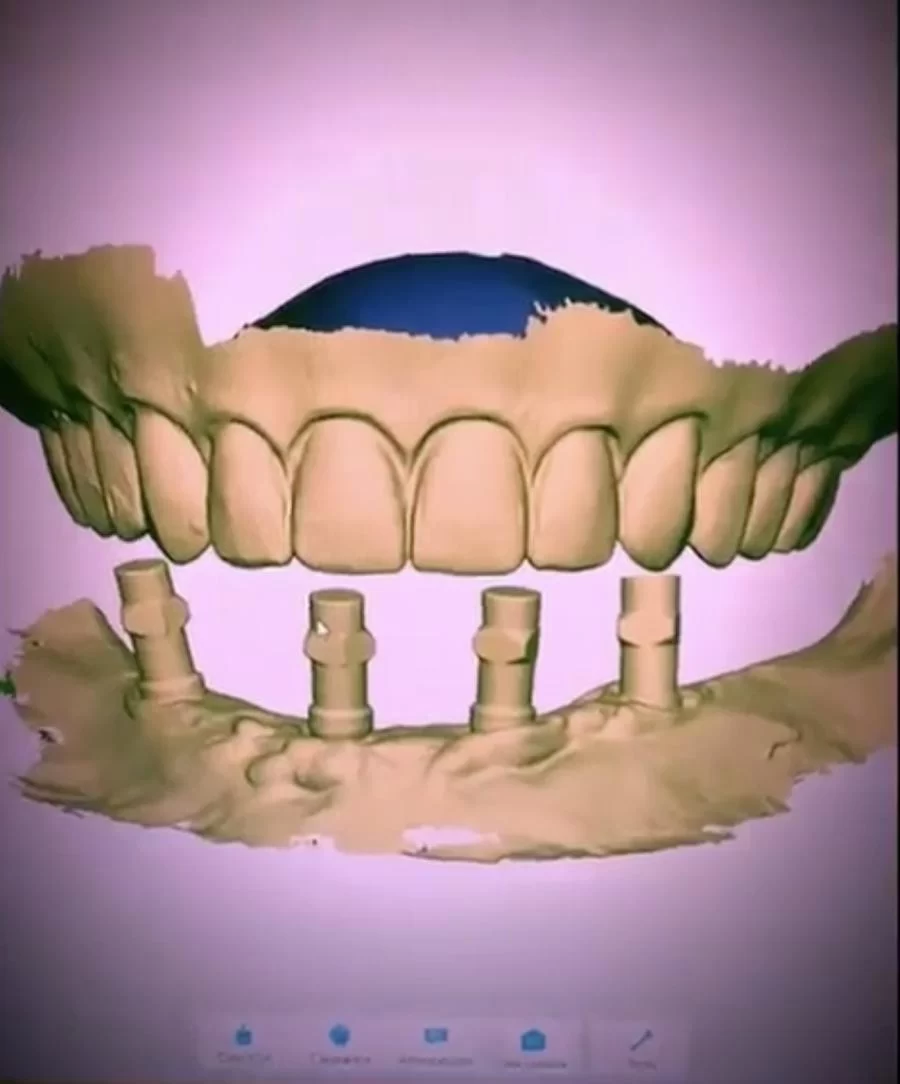 Burbank Dental Implants: Ramsey A. Amin D.D.S. Picture 5