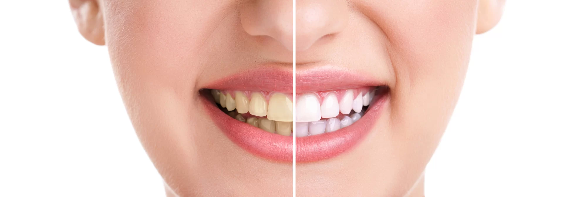The Benefits of Professional Teeth Whitening: Achieve a Brighter, Healthier Smile