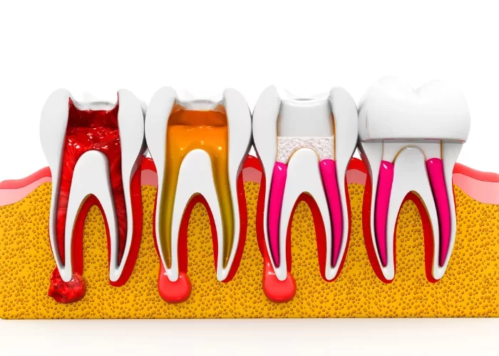 Best Dentist for Root Canal Procedures in Chicago: Find Expert Care and Relief