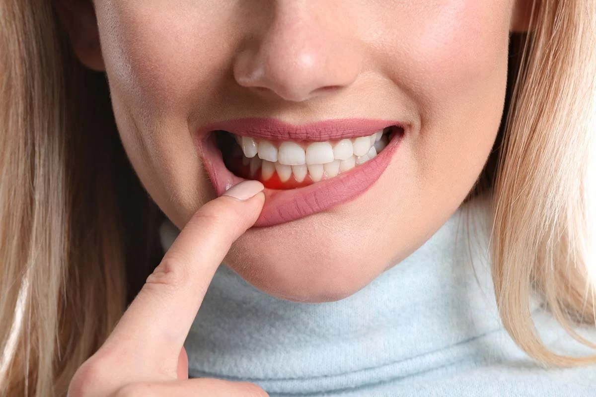 Best Ways to Reduce Gum Inflammation: Simple and Effective Remedies