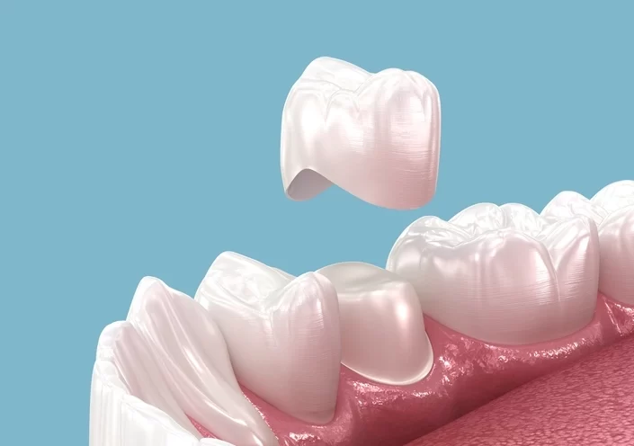 How Long Do Dental Crowns Last? Comprehensive Guide to Longevity