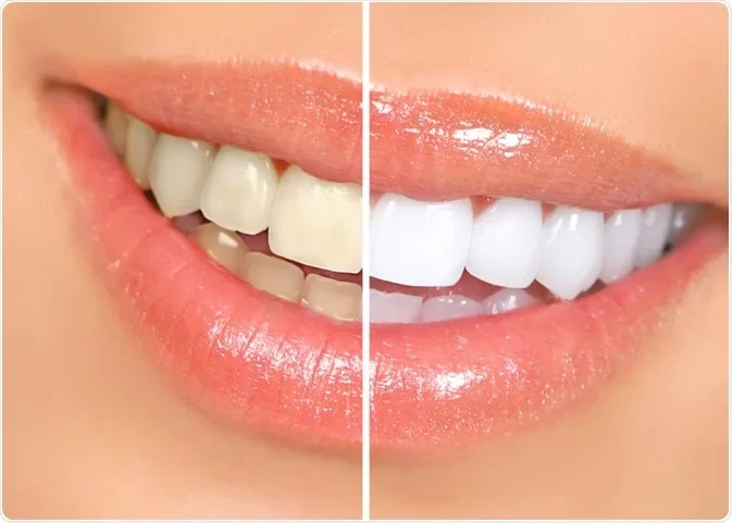 Effective Teeth Whitening Solutions for Smokers in New York: Restore Your Bright Smile