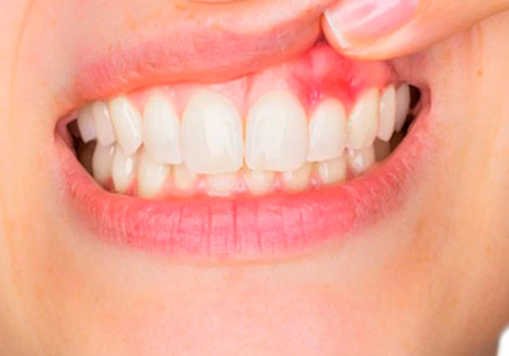 Effective Gum Disease Treatment: How to Prevent and Treat Gum Disease Naturally