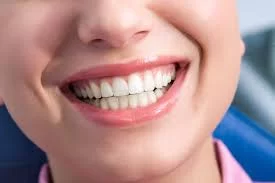 Transform Your Smile with Veneers: A Comprehensive Guide