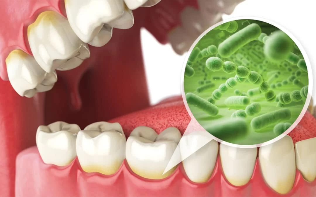 How to Manage the Impact of Oral Bacteria on Overall Health