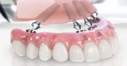 The Ultimate Guide to Pain-Free Dental Implants in New York: Transform Your Smile Comfortably