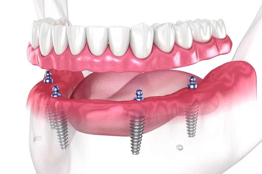 San Fernando & Pacoima Family Dental Picture 4