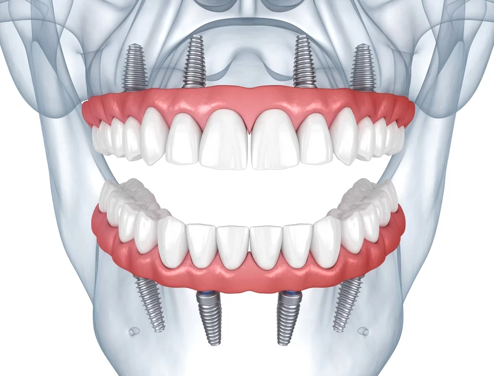All-on-4 Dental Implants: A Comprehensive Guide to Full Mouth Restoration