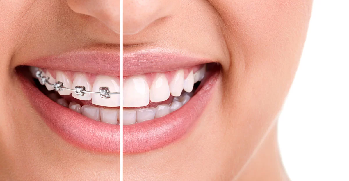 Getting Braces for Aesthetic Reasons: How Braces Improve Your Smile and Confidence