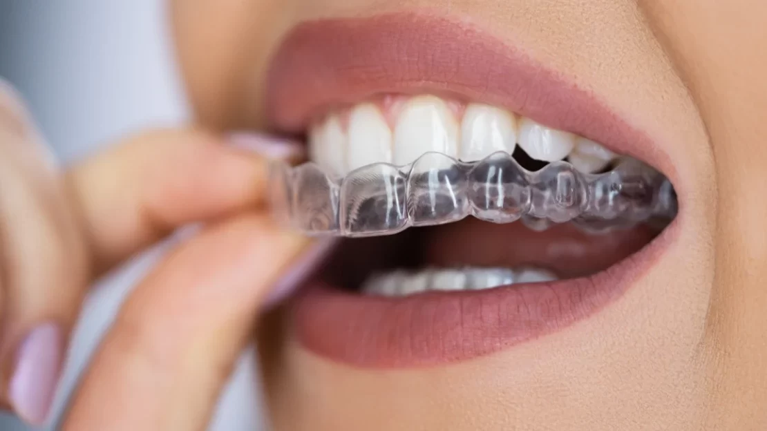 Clear Braces for Discreet Orthodontic Treatment: The Future of Invisible Aligners