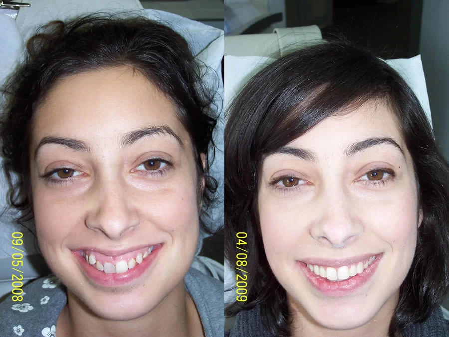 Rapid Braces Picture 5
