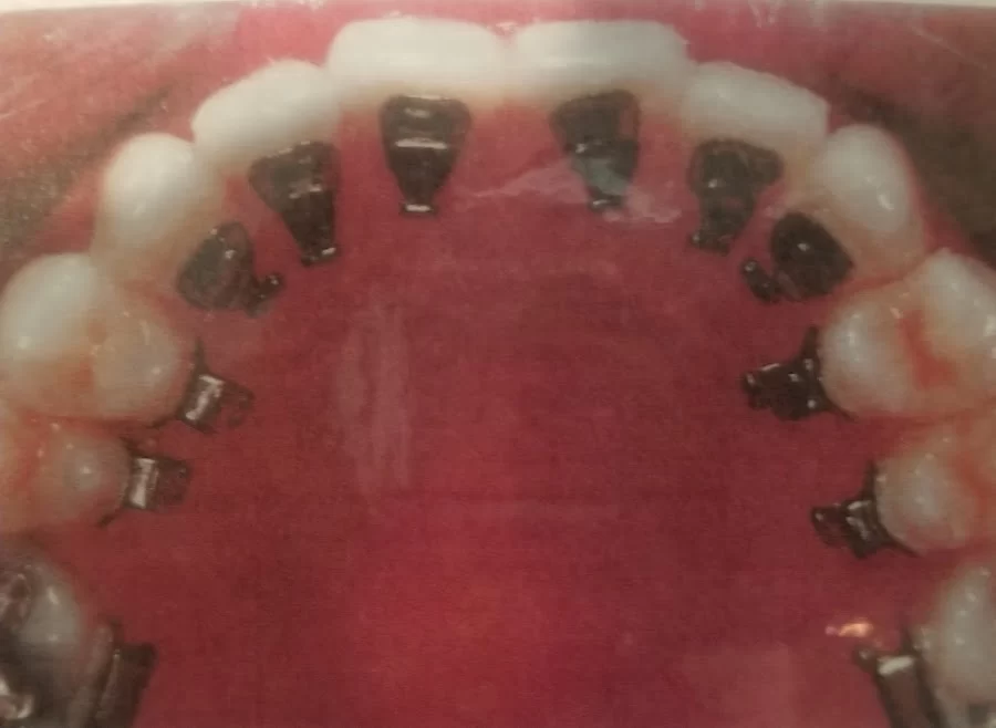 Rapid Braces Picture 1
