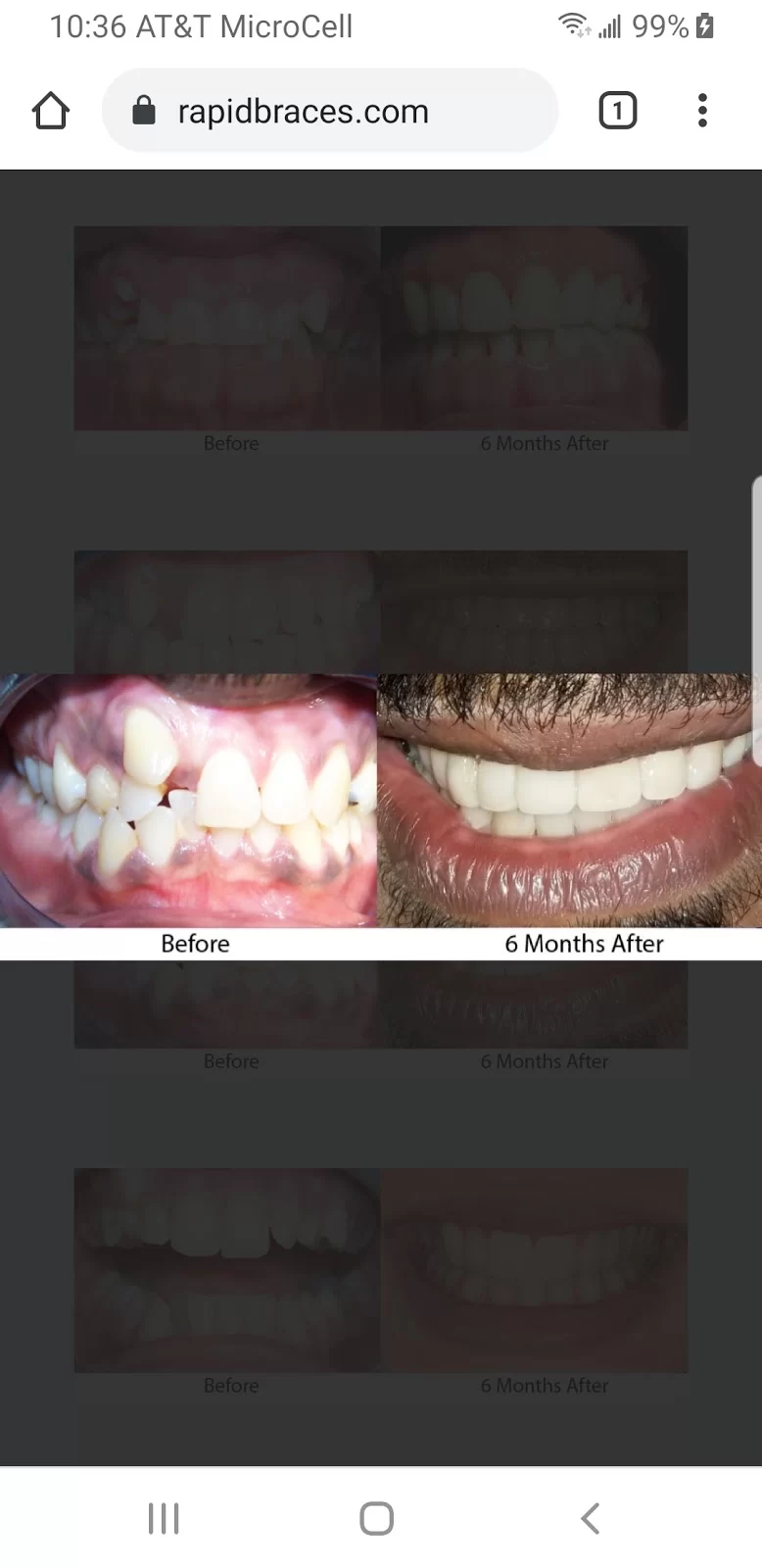 Rapid Braces Picture 7