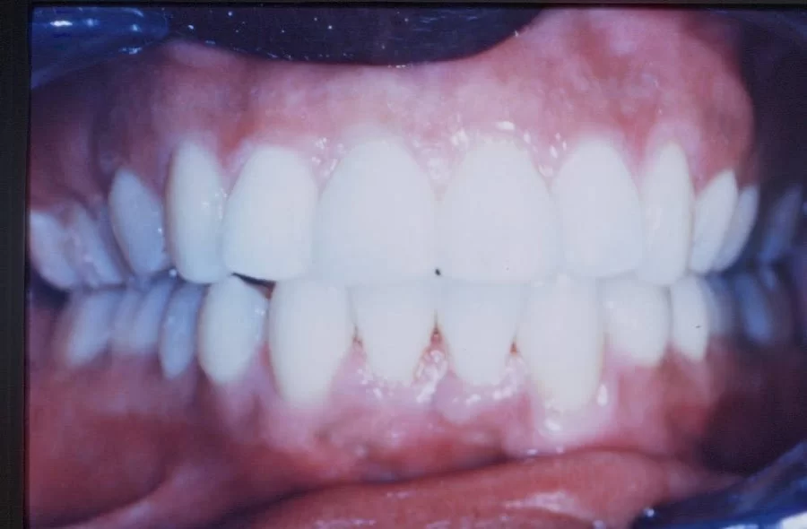 Rapid Braces Picture 3
