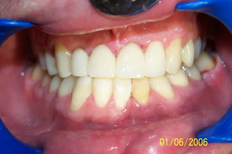Rapid Braces Picture 2