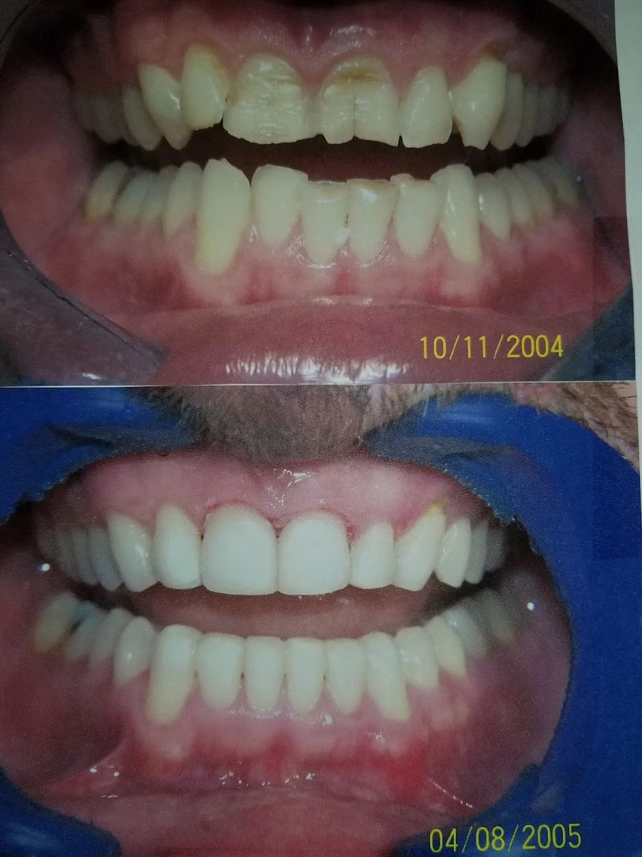 Rapid Braces Picture 8