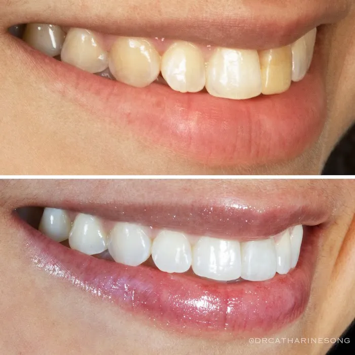 Beverly Hills Dental Song Cosmetic Dentist: Porcelain Veneers, Teeth Whitening, Invisalign Picture 10