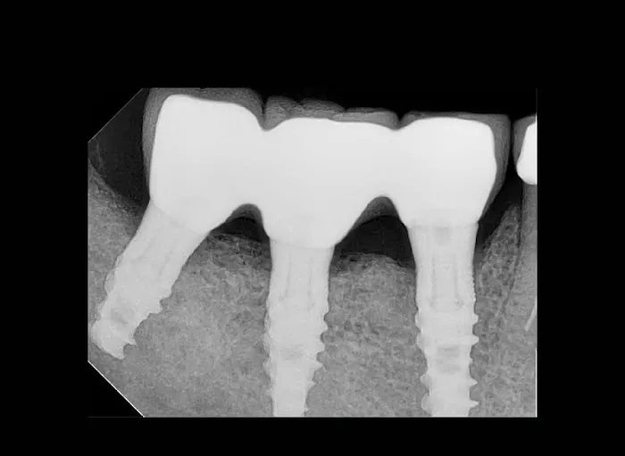 DENTOFIT DENTAL CLINIC - Top Dentist in Punawale IMPLANT | DENTAL | SKIN-HAIR (FIRST FLOOR पहिला मजला) Picture 5