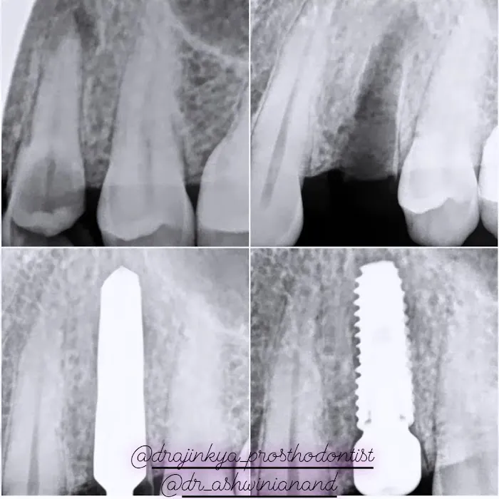 DENTOFIT DENTAL CLINIC - Top Dentist in Punawale IMPLANT | DENTAL | SKIN-HAIR (FIRST FLOOR पहिला मजला) Picture 7