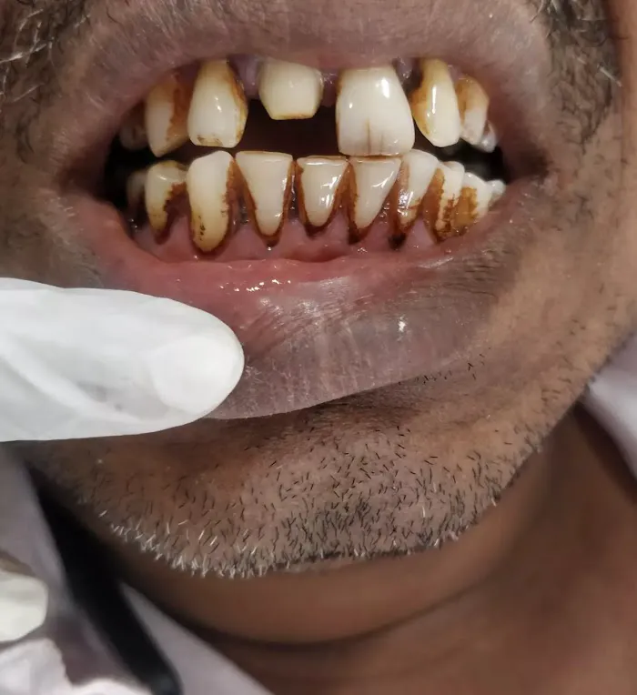 Wellness Dental clinic best dentist | Dr sangeetha| aligners , implant ,vaneers,root canal |RCT| best dental clinic wakad Picture 10