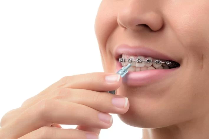 Tooth Decay and Orthodontic Braces: How to Protect Your Teeth During Treatment