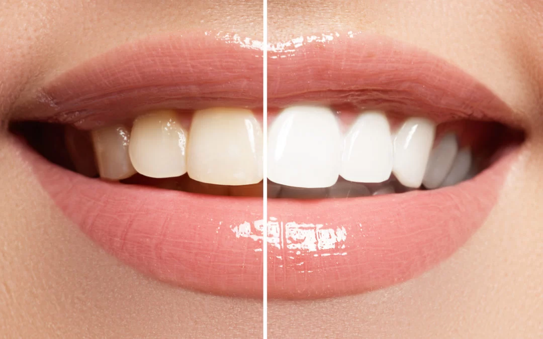 The Importance of Routine Teeth Whitening for Healthy, White Teeth: Essential Tips for a Brighter Smile