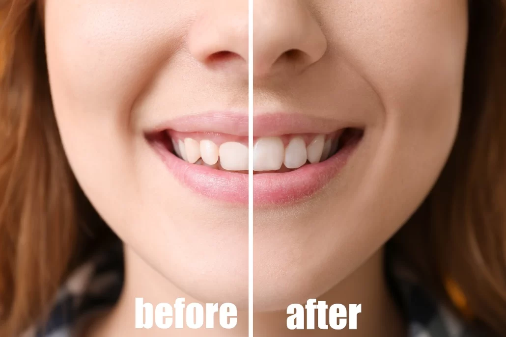 How Bite Alignment Affects Overall Facial Symmetry: Importance of Dental Care for a Balanced Look