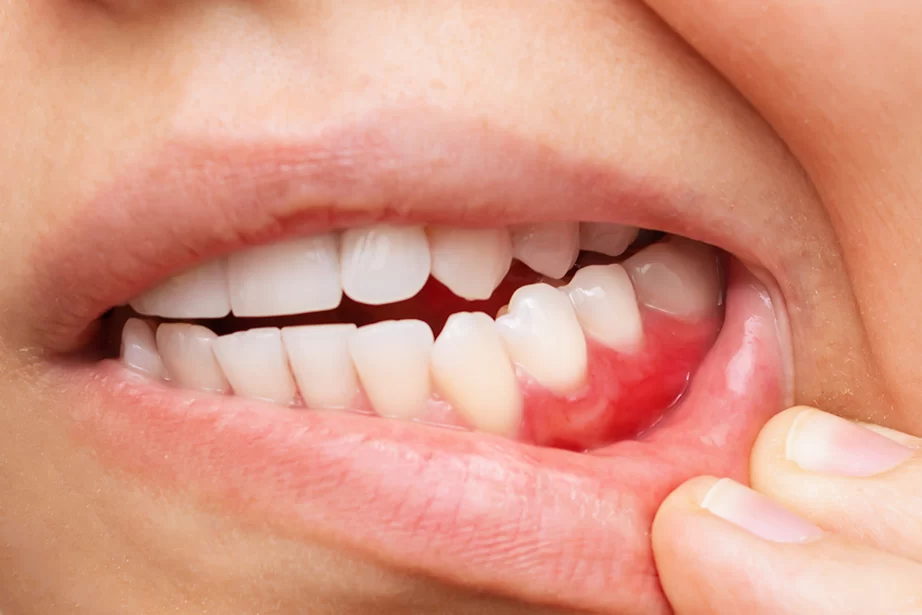 Advanced Treatments for Gum Recession: Innovative Solutions for Restoring Gum Health