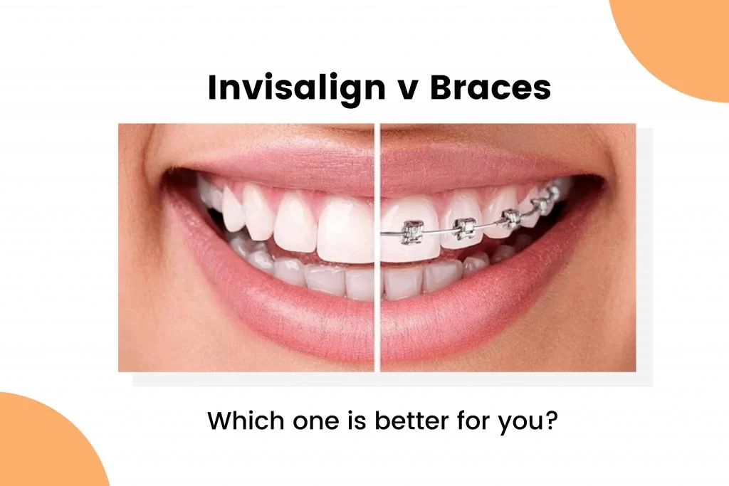 Invisalign vs. Braces: Which Option is Best for You?