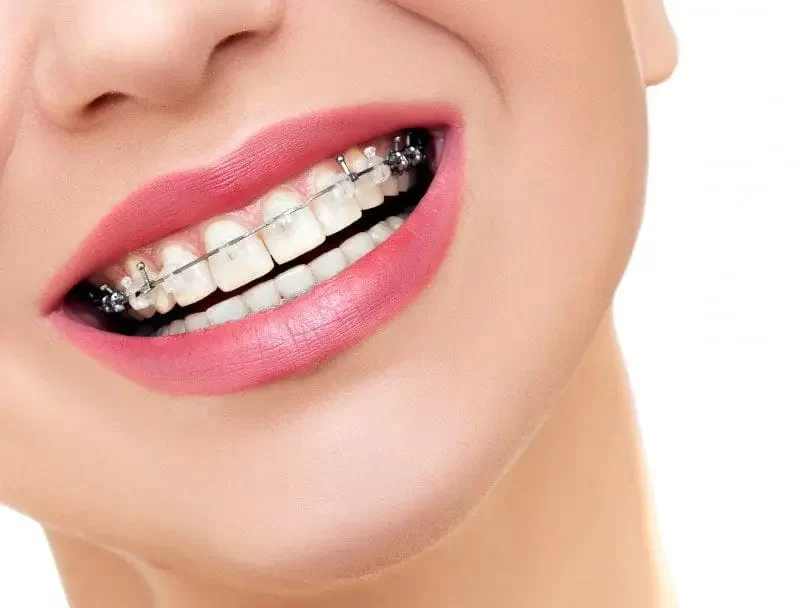 Understanding the Cost of Orthodontic Treatment with Braces