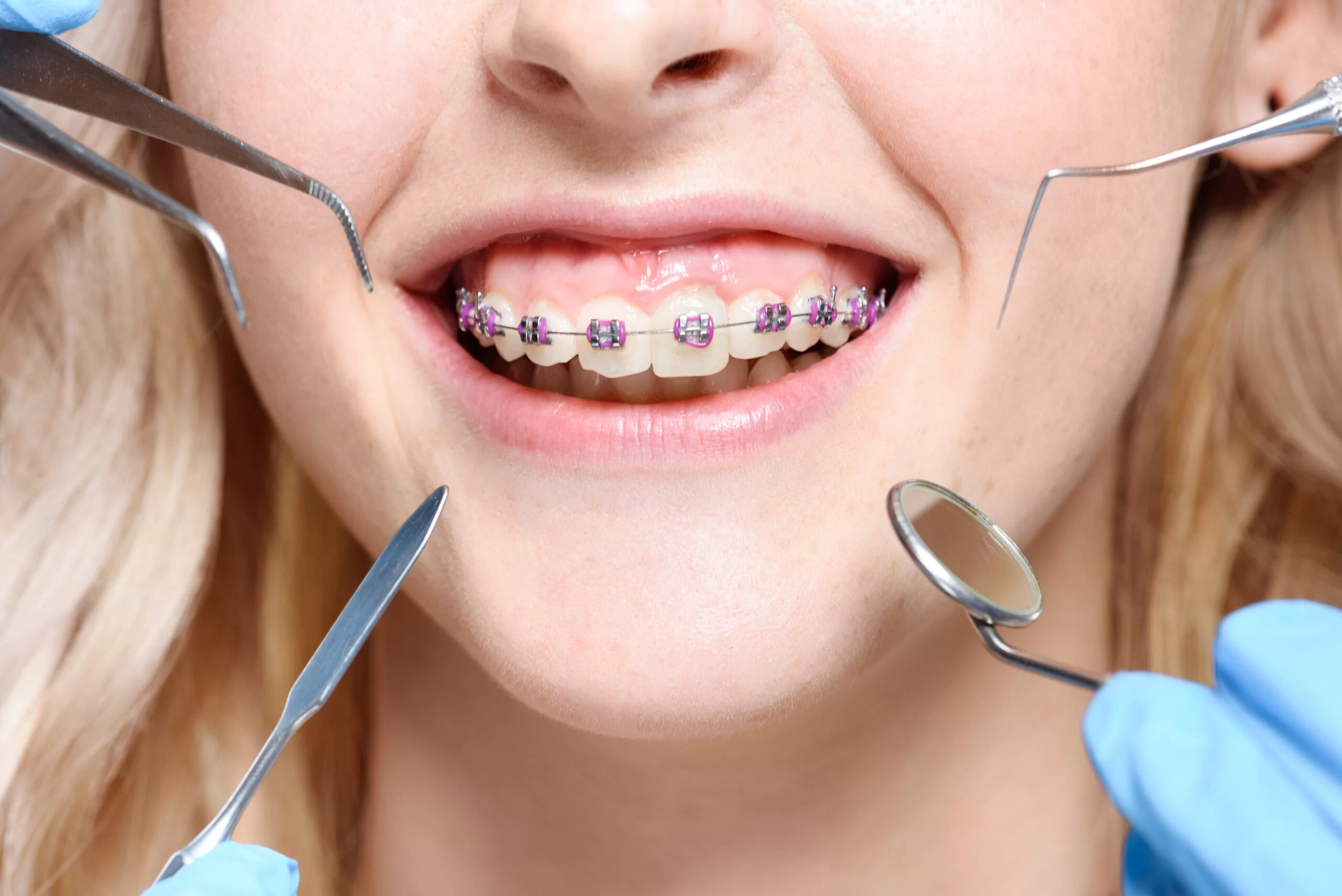 Essential Dental Care Tips for People with Braces: Keep Your Teeth and Gums Healthy