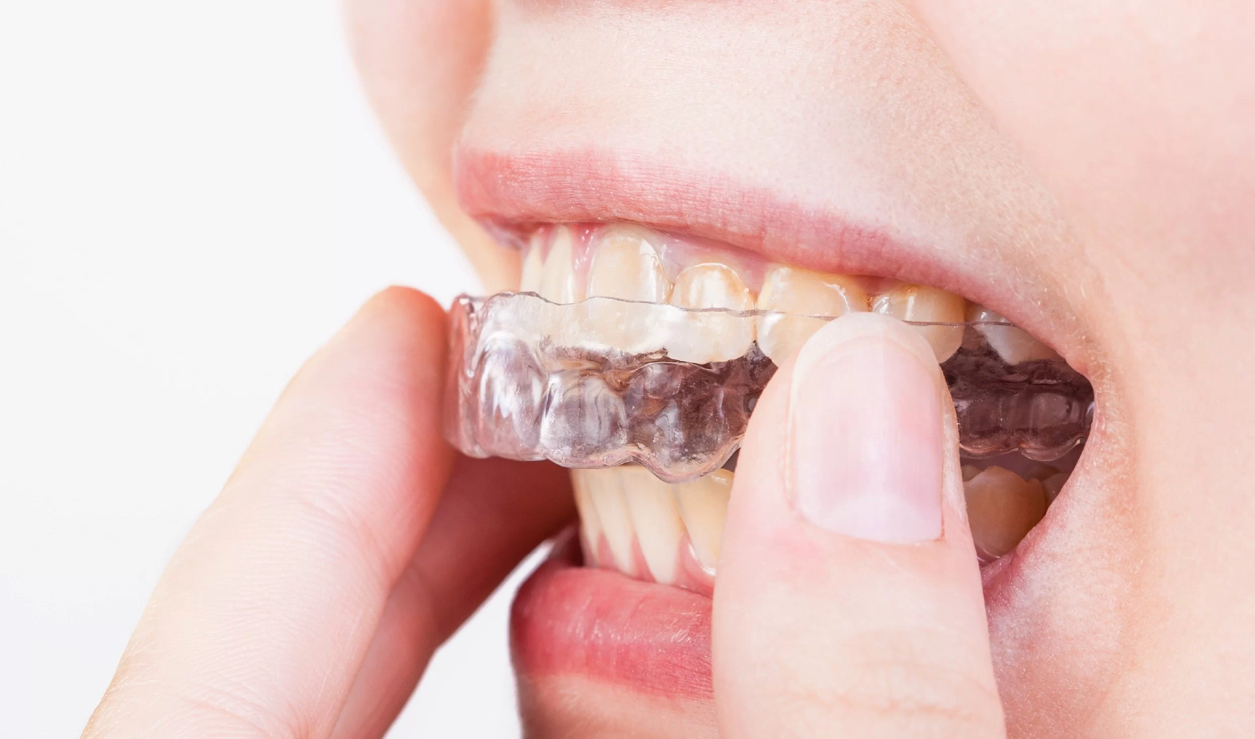 How to Protect Your Teeth from Grinding: Effective Tips for Healthy Teeth