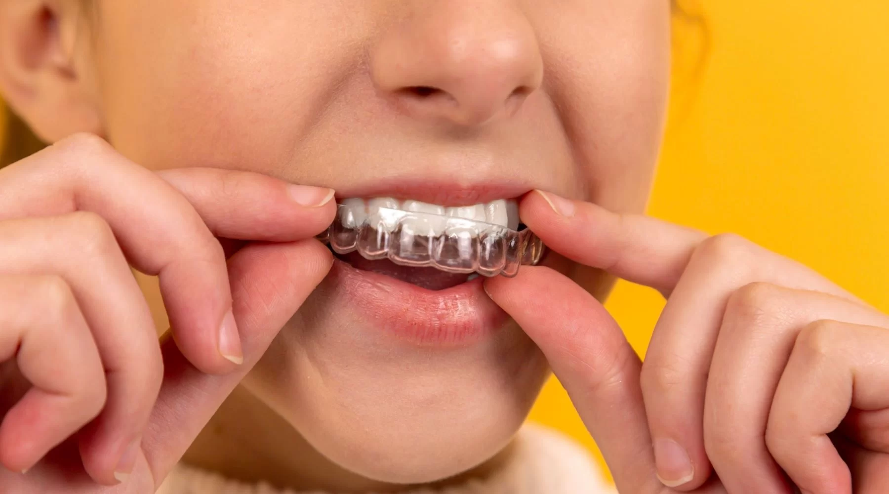 Best Braces for Adults: A Comprehensive Guide