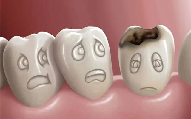 How Long Does It Take for Tooth Decay to Progress?