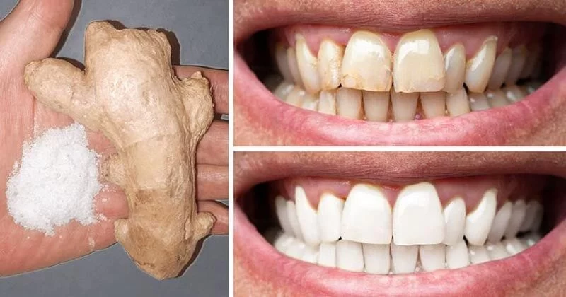 Effective DIY Teeth Whitening Remedies You Can Try at Home