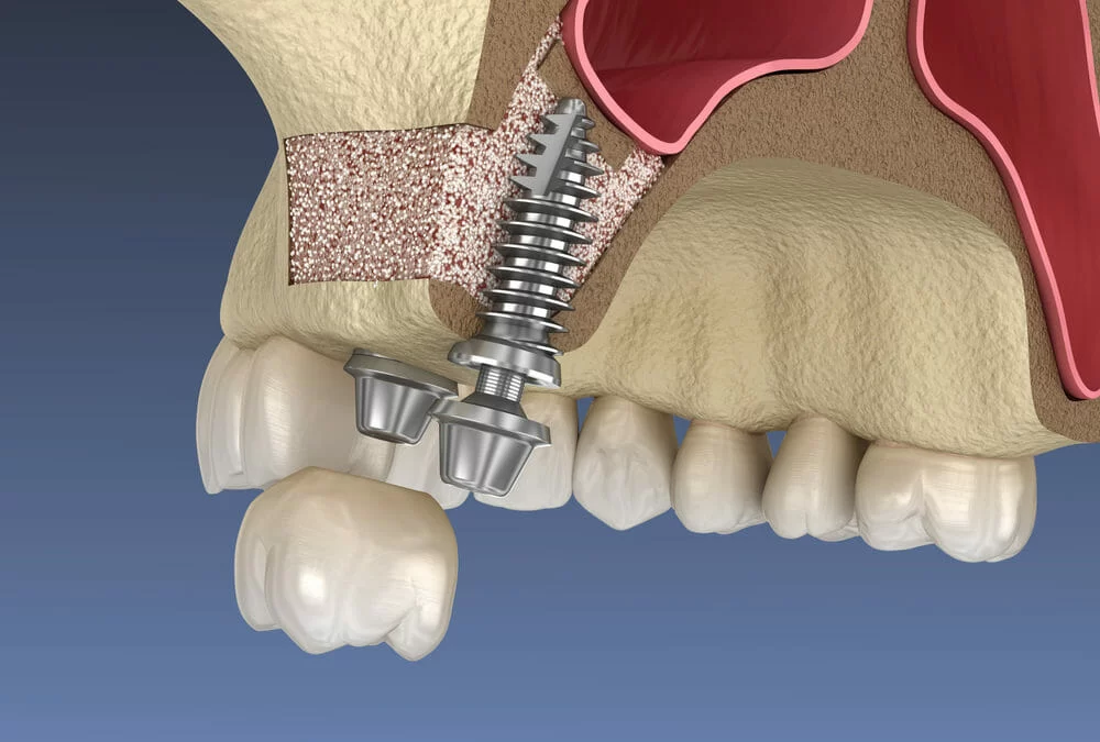 What is Sinus Lift Surgery for Dental Implants? Understanding the Procedure and Benefits