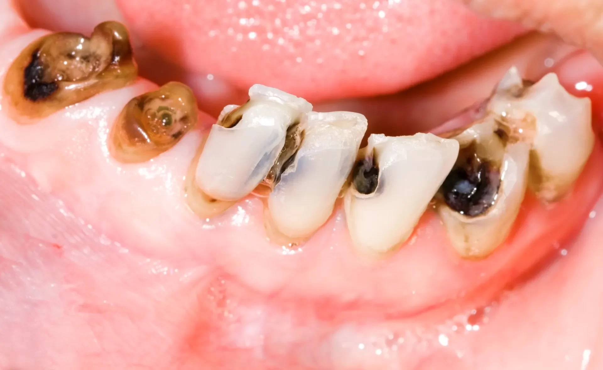 How Tooth Decay Spreads Over Time: Stages and Prevention Tips