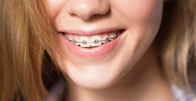 Braces for Teeth Crowding: A Comprehensive Guide to Treatment Options
