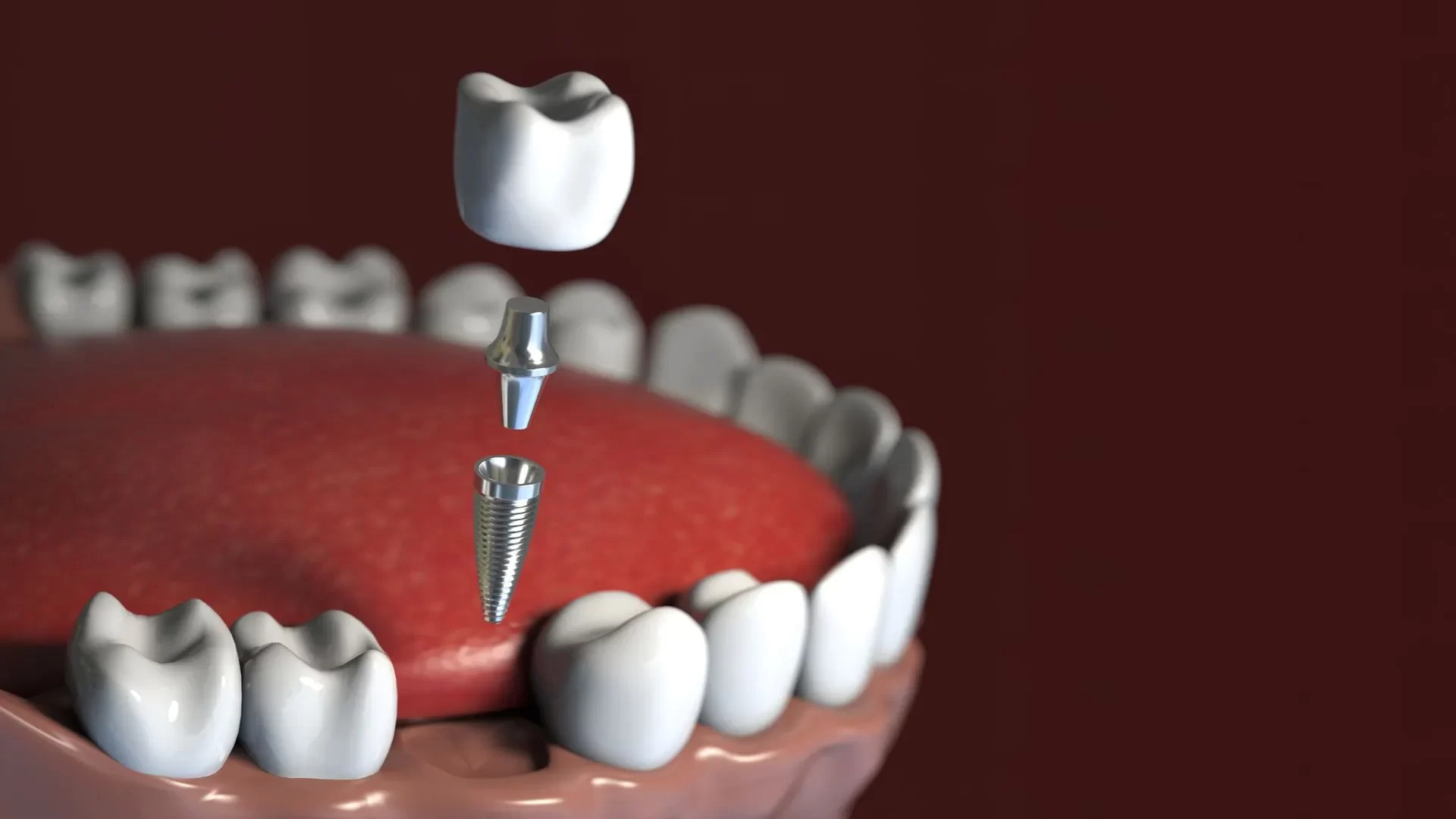 Understanding the Success Rate of Dental Implants: Insights and Real-Life Stories