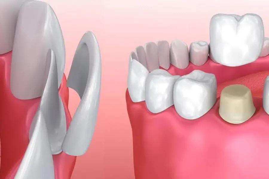 Understanding the Difference Between a Dental Crown and a Dental Veneer: Comprehensive Guide