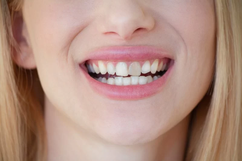 Treatment for Tooth Discoloration