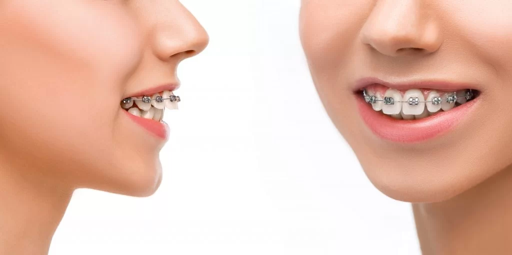 Braces for Over-Crowded Teeth: Effective Solutions for a Perfect Smile