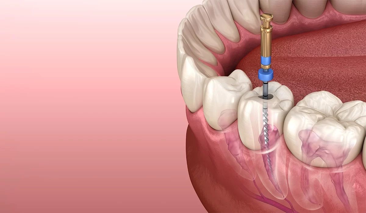 What is the Recovery Time After Getting a Root Canal? A Complete Guide to Healing