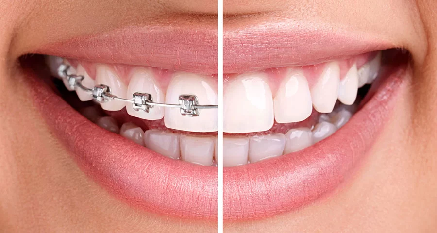 How Long Do Braces Take to Straighten Teeth? A Complete Guide