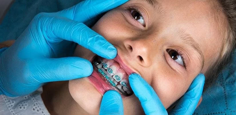How to Care for Your Child's Teeth During Orthodontic Treatment
