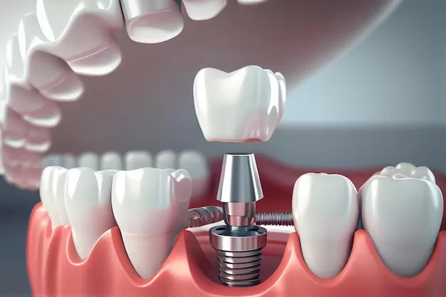 How to Improve the Longevity of Dental Implants: Essential Care Tips