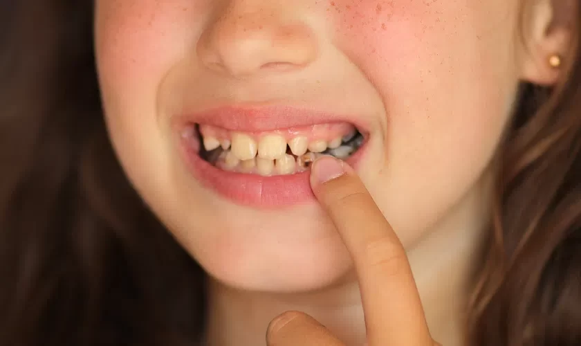 Tooth Decay and Its Relationship to Oral Cancer: Understanding the Connection