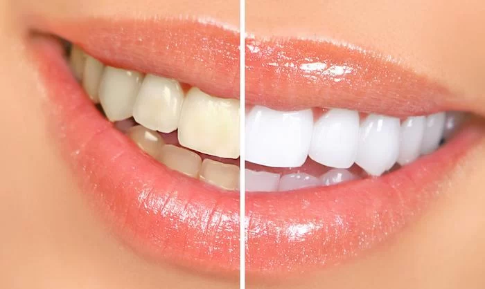 What Are the Most Effective Teeth Whitening Treatments? Discover the Best Options for Brightening Your Smile