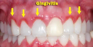 How to Prevent Gingivitis: Essential Tips for Healthy Gums