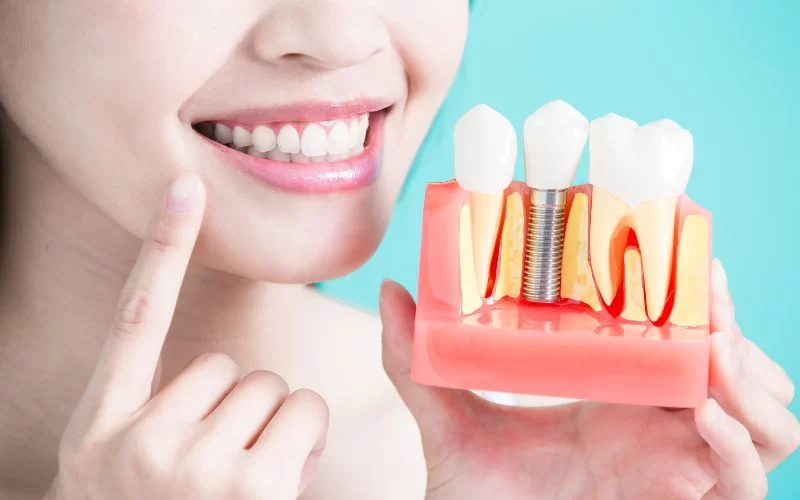 What is the Success Rate of Dental Implants?